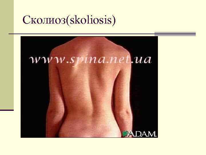 Сколиоз(skoliosis) 