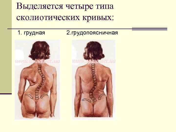 Выделяется четыре типа сколиотических кривых: 1. грудная 2. грудопоясничная 