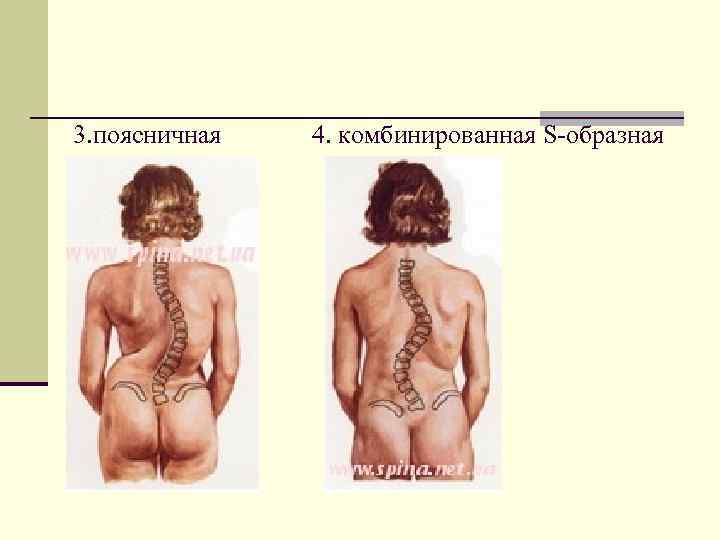 3. поясничная 4. комбинированная S-образная 