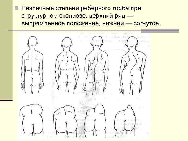 n Различные степени реберного горба при структурном сколиозе: верхний ряд — выпрямленное положение, нижний