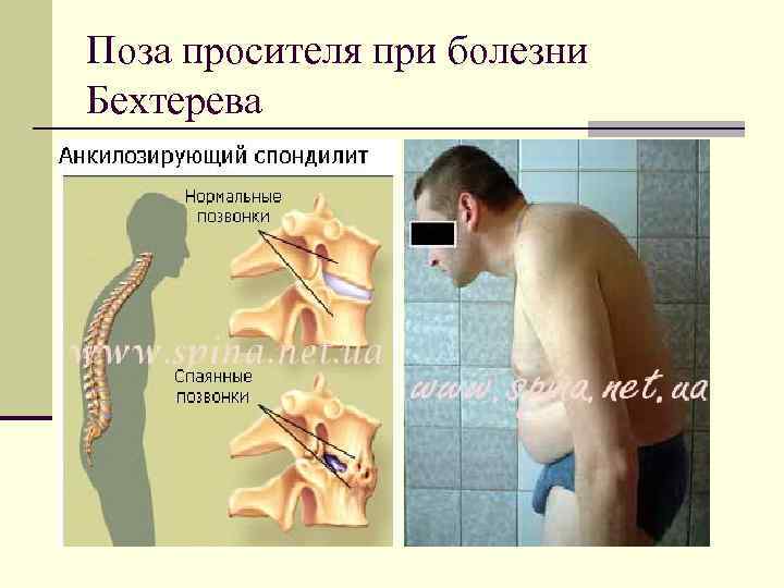 Поза просителя при болезни Бехтерева 