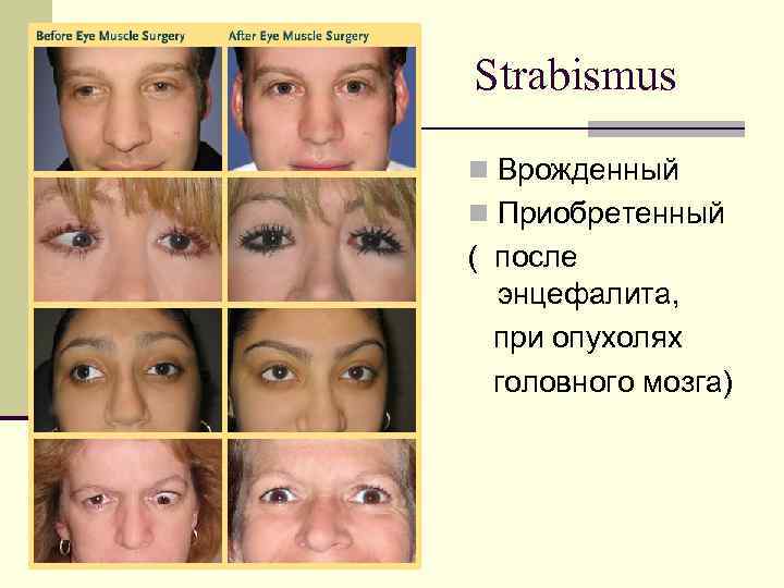 Strabismus n Врожденный n Приобретенный ( после энцефалита, при опухолях головного мозга) 