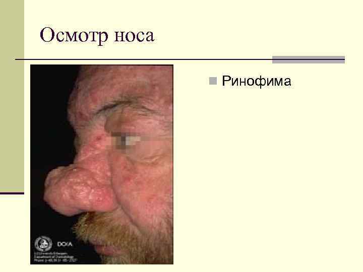 Осмотр носа n Ринофима 