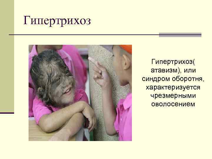 Гипертрихоз( атавизм), или синдром оборотня, характеризуется чрезмерными оволосением 