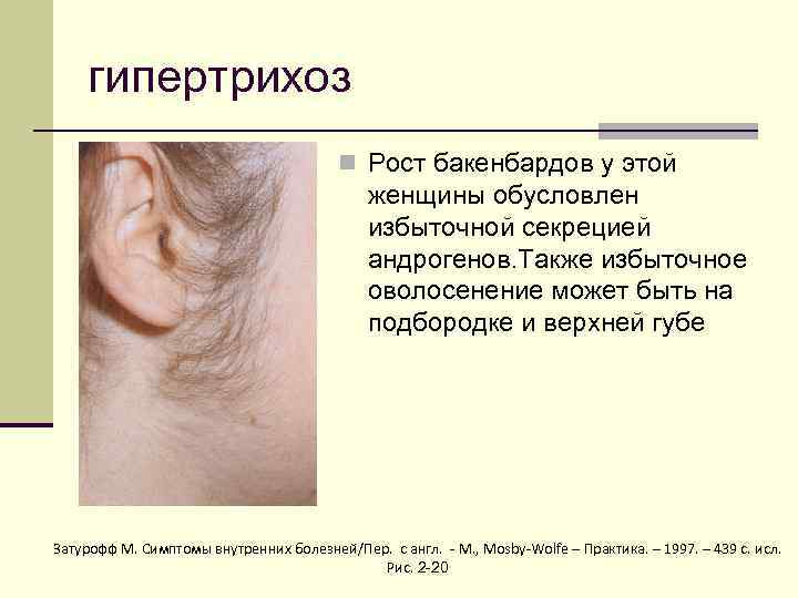 гипертрихоз n Рост бакенбардов у этой женщины обусловлен избыточной секрецией андрогенов. Также избыточное оволосенение