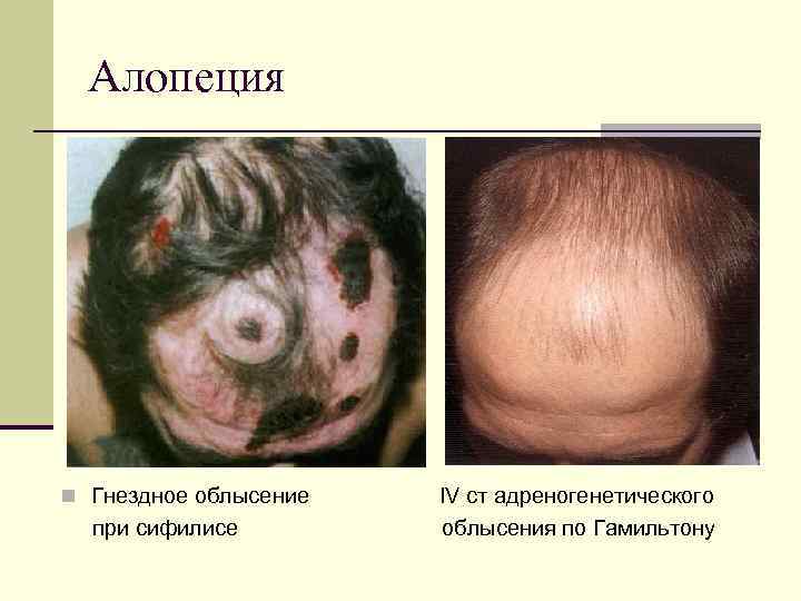 Алопеция n Гнездное облысение IV ст адреногенетического при сифилисе облысения по Гамильтону 