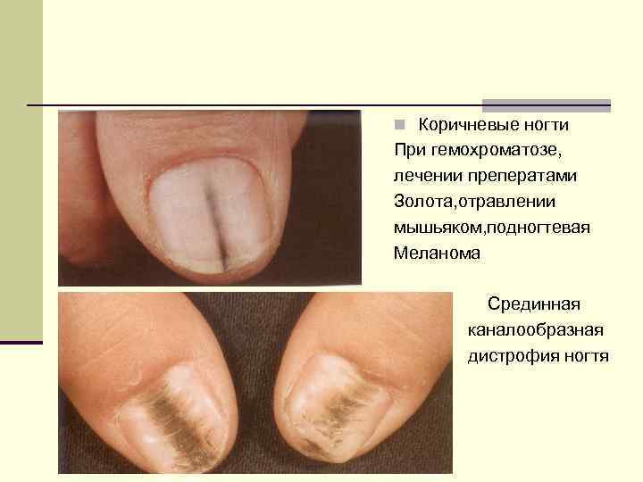 n Коричневые ногти При гемохроматозе, лечении преператами Золота, отравлении мышьяком, подногтевая Меланома Срединная каналообразная