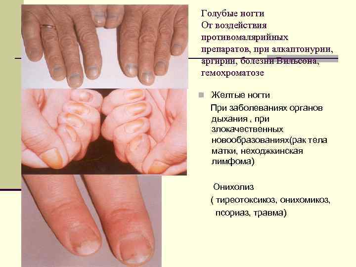 Голубые ногти От воздействия противомалярийных препаратов, при алкаптонурии, аргирии, болезни Вильсона, гемохроматозе n Желтые