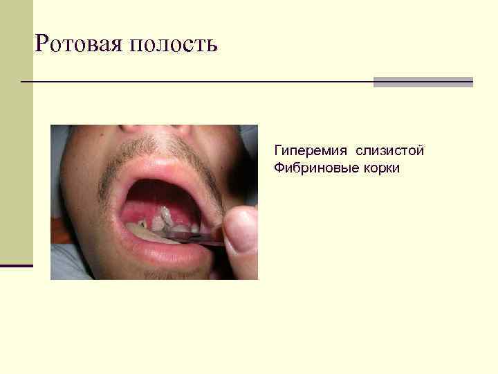 Ротовая полость Гиперемия слизистой Фибриновые корки 