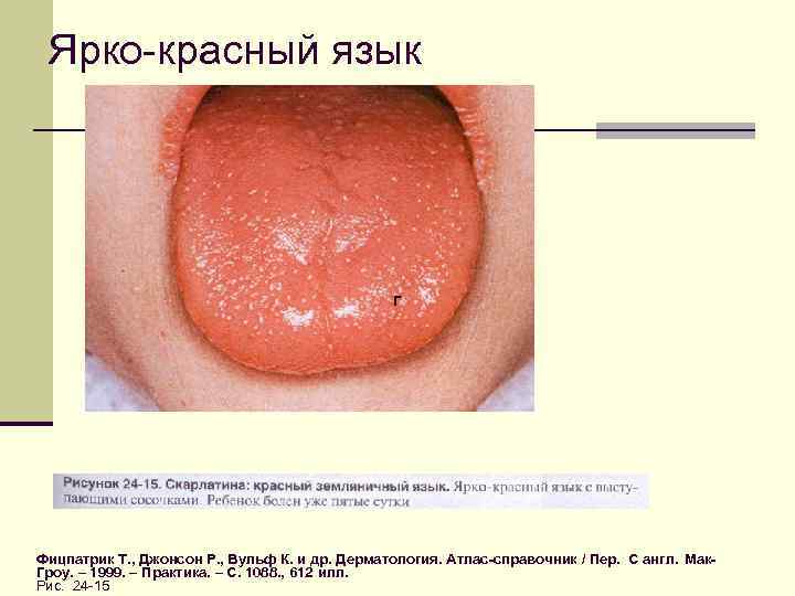 Ярко-красный язык г Фицпатрик Т. , Джонсон Р. , Вульф К. и др. Дерматология.