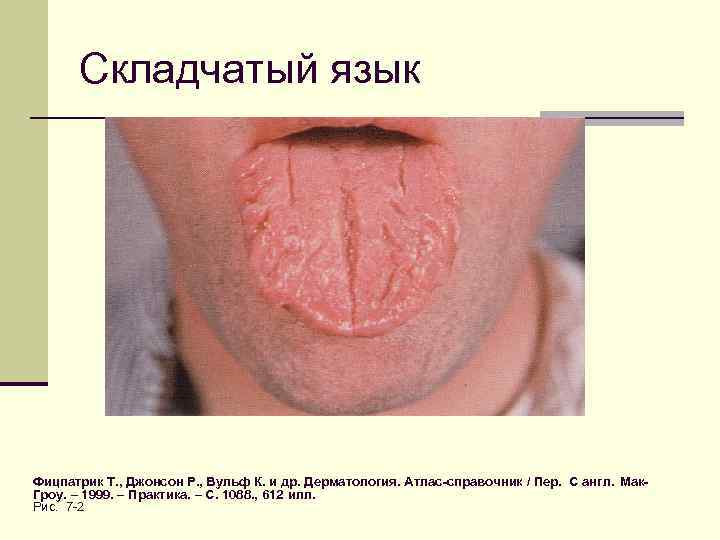 Складчатый язык Фицпатрик Т. , Джонсон Р. , Вульф К. и др. Дерматология. Атлас-справочник