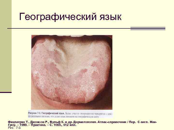 Географический язык Фицпатрик Т. , Джонсон Р. , Вульф К. и др. Дерматология. Атлас-справочник