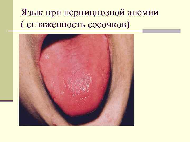 Язык при пернициозной анемии ( сглаженность сосочков) 