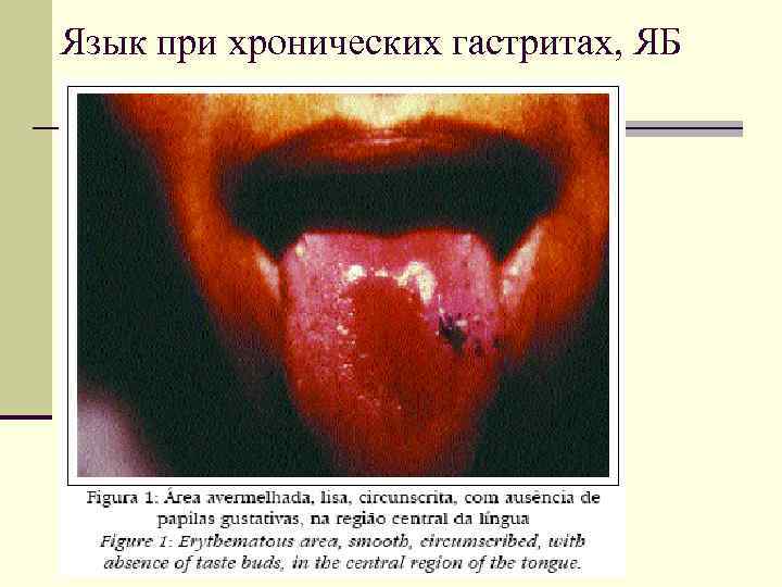 Язык при хронических гастритах, ЯБ 