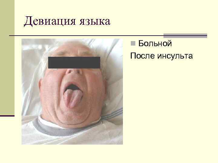 Девиация языка n Больной После инсульта 