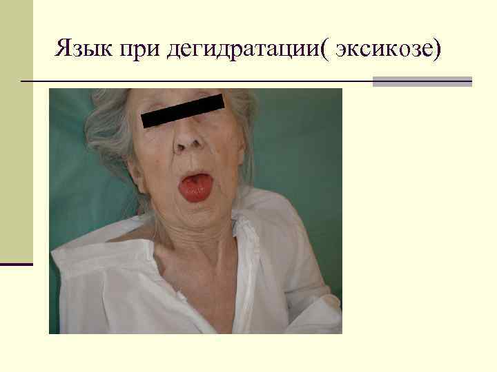 Язык при дегидратации( эксикозе) 