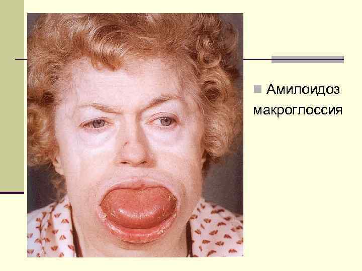 n Амилоидоз макроглоссия 