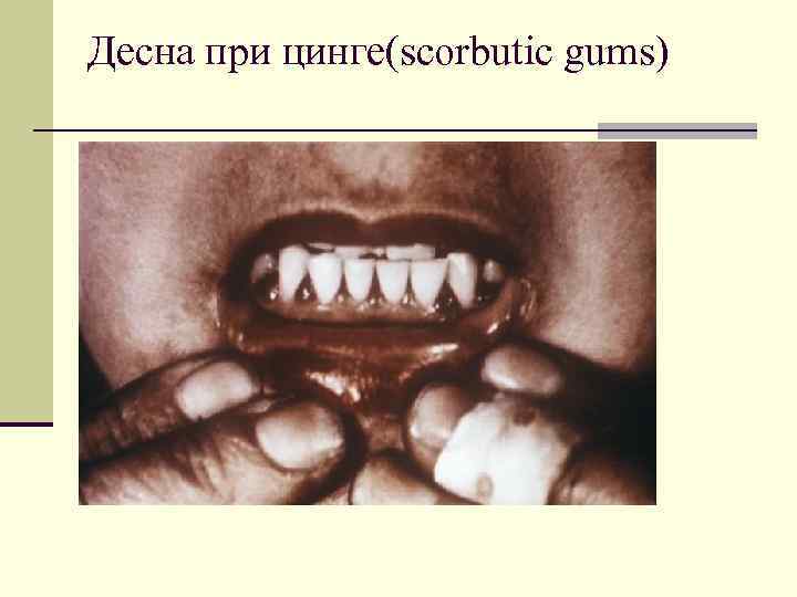 Десна при цинге(scorbutic gums) 