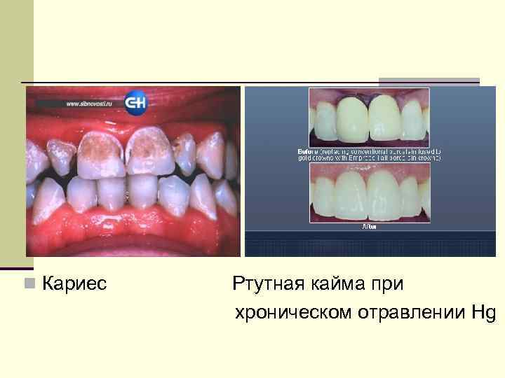 n Кариес Ртутная кайма при хроническом отравлении Hg 
