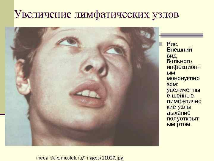 Увеличение лимфатических узлов n Рис. Внешний вид больного инфекционн ым мононуклео зом: увеличенны е