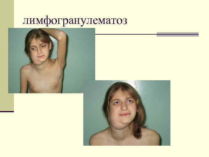 лимфогранулематоз 