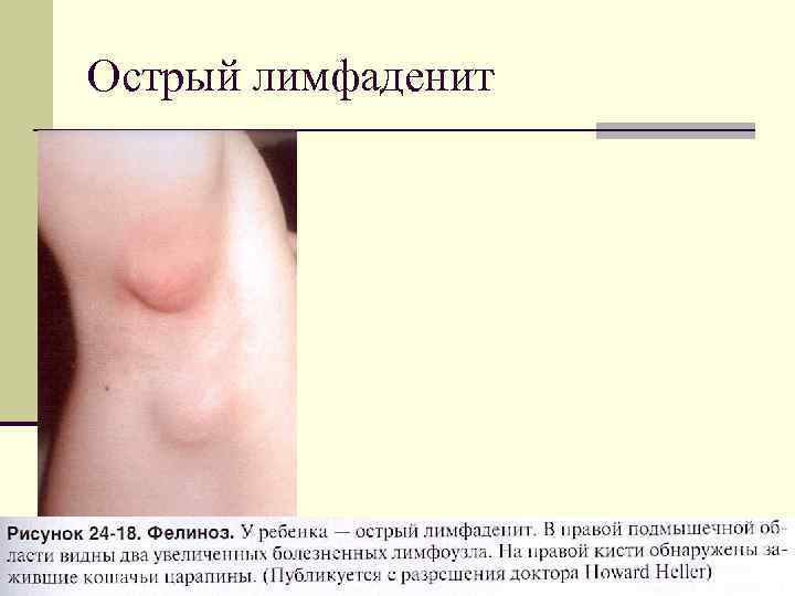 Острый лимфаденит 