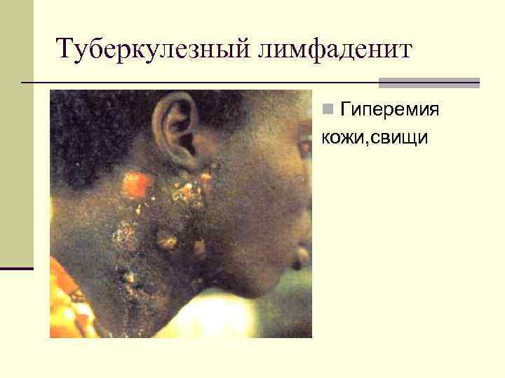 Туберкулезный лимфаденит n Гиперемия кожи, свищи 