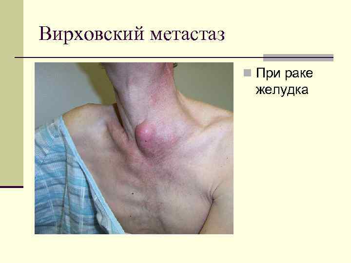 Вирховский метастаз n При раке желудка 