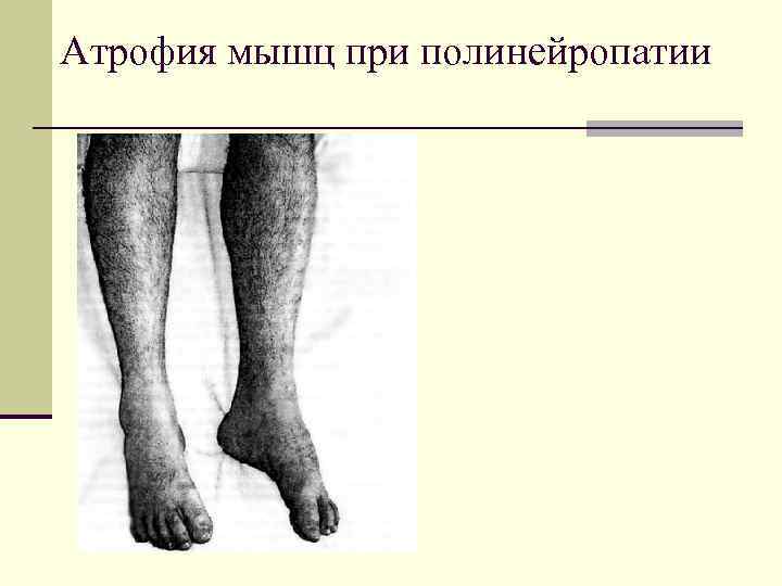Атрофия мышц при полинейропатии 