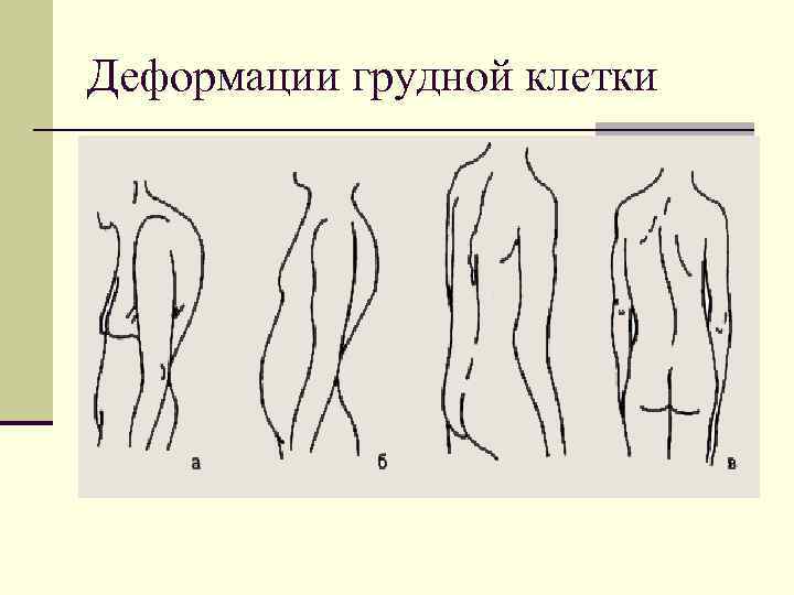 Деформации грудной клетки 