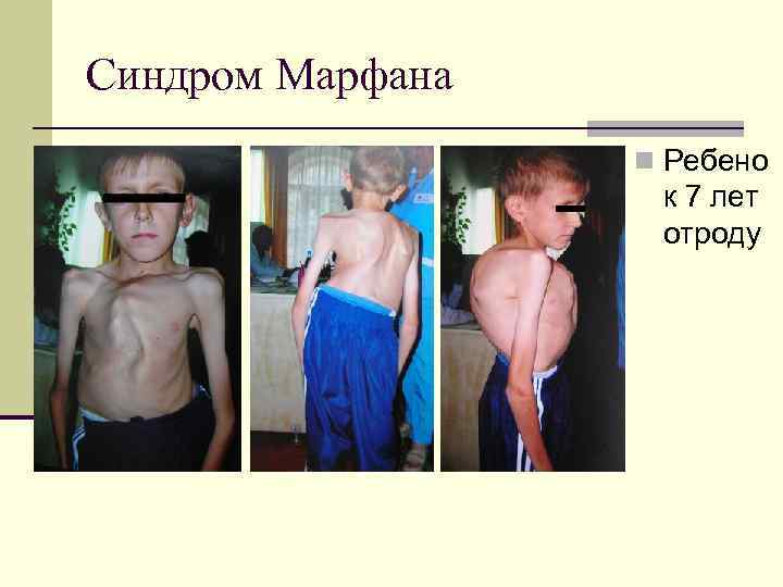 Синдром Марфана n Ребено к 7 лет отроду 