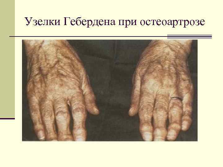 Узелки Гебердена при остеоартрозе 