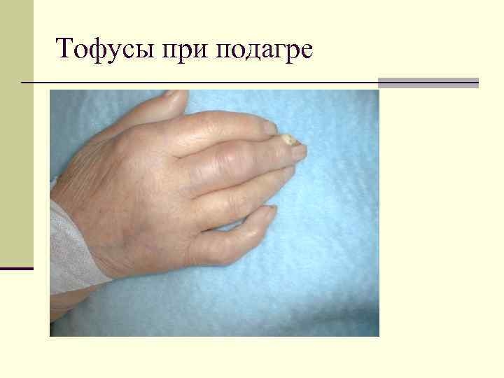 Тофусы при подагре 