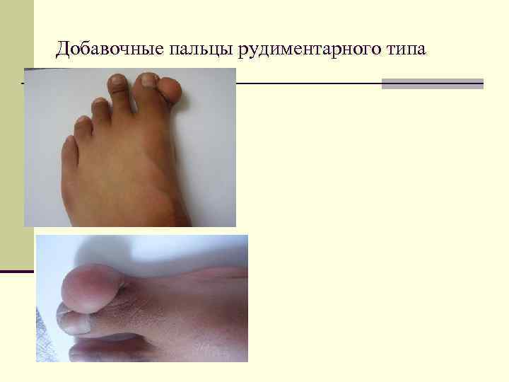 Добавочные пальцы рудиментарного типа 