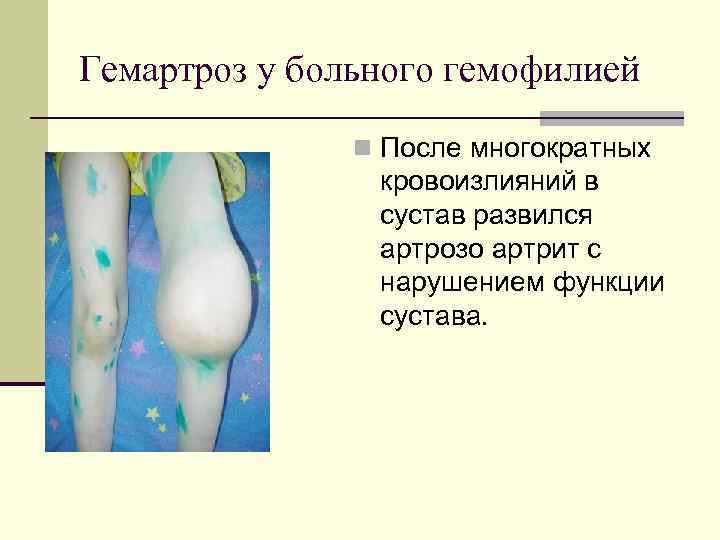 Гемартроз у больного гемофилией n После многократных кровоизлияний в сустав развился артрозо артрит с
