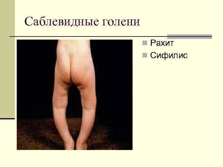 Саблевидные голени n Рахит n Сифилис 