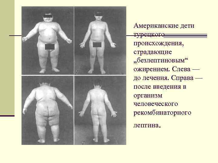 Американские дети турецкого происхождения, страдающие „безлептиновым“ ожирением. Слева — до лечения. Справа — после