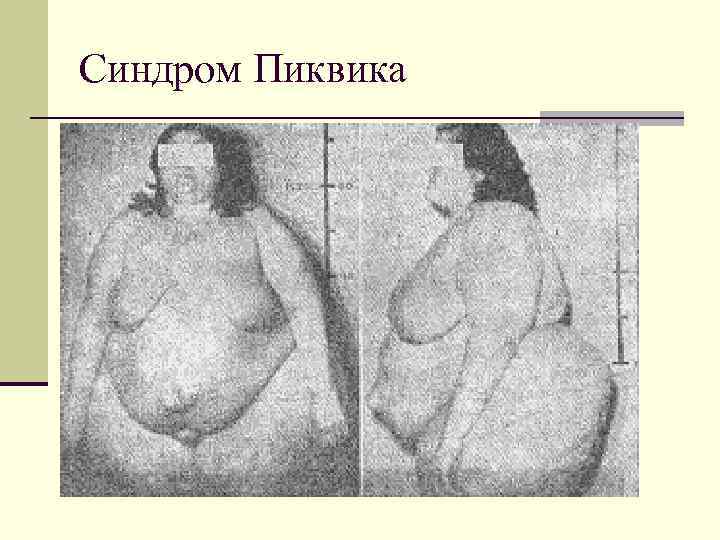 Синдром Пиквика 