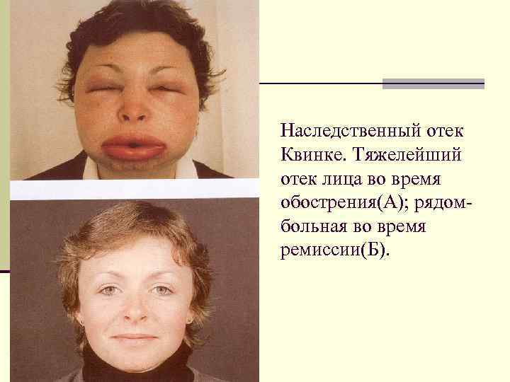 Наследственный отек Квинке. Тяжелейший отек лица во время обострения(А); рядомбольная во время ремиссии(Б). 