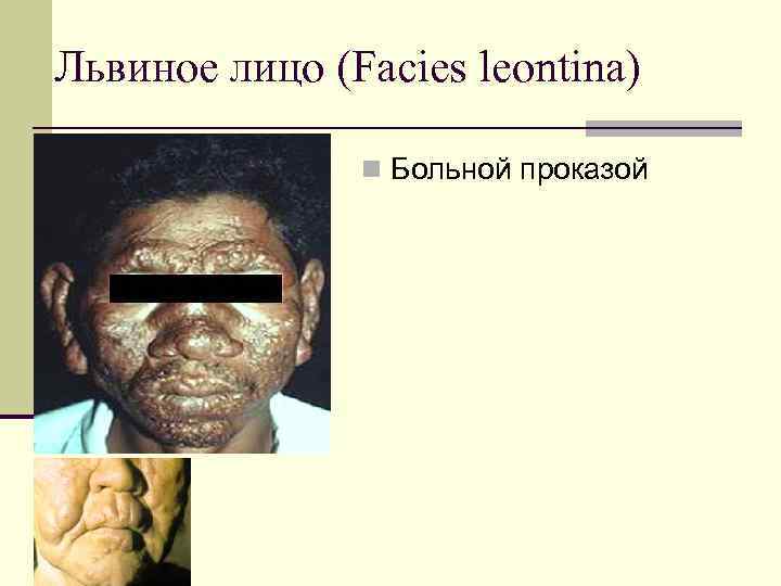 Львиное лицо (Facies leontina) n Больной проказой 