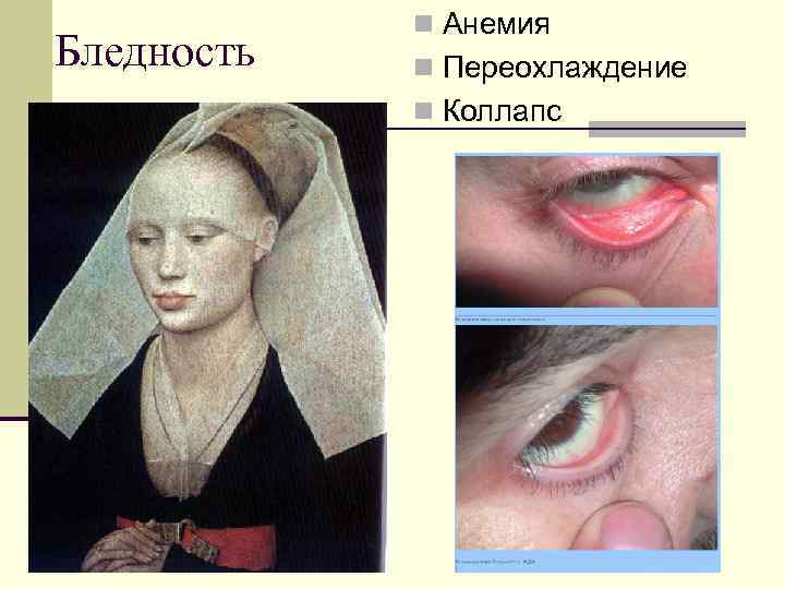 Бледность n Анемия n Переохлаждение n Коллапс 