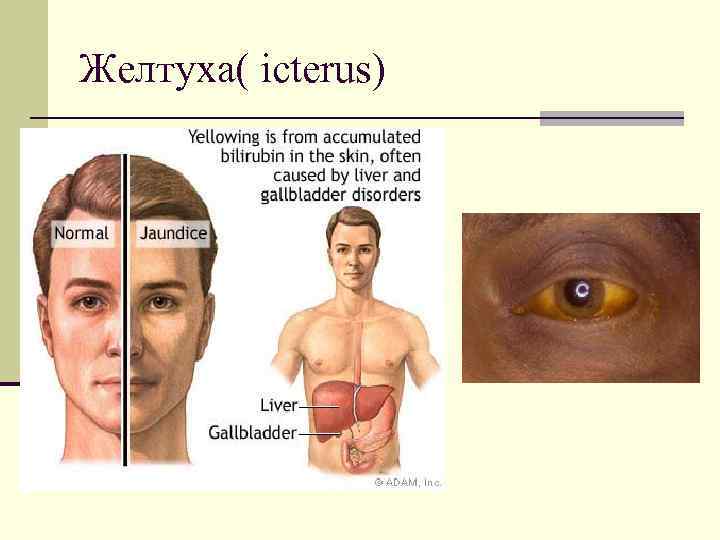 Желтуха( icterus) 