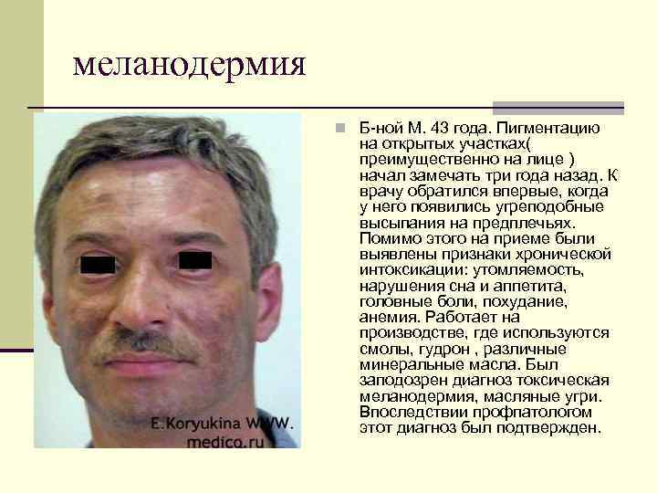 меланодермия n Б-ной М. 43 года. Пигментацию на открытых участках( преимущественно на лице )