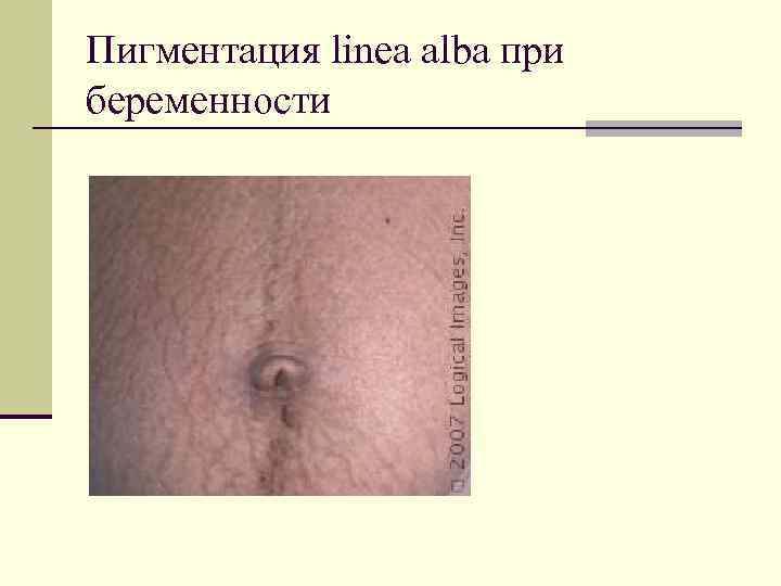 Пигментация linea alba при беременности 