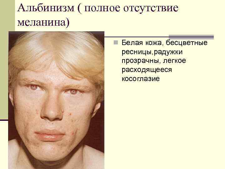 Альбинизм ( полное отсутствие меланина) n Белая кожа, бесцветные ресницы, радужки прозрачны, легкое расходящееся