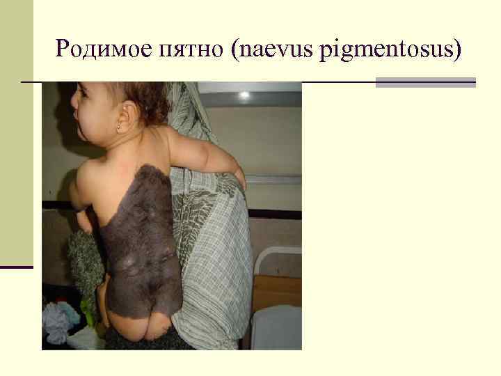 Родимое пятно (naevus pigmentosus) 