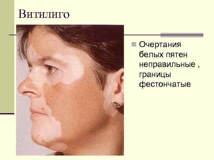 Витилиго n Очертания белых пятен неправильные , границы фестончатые 