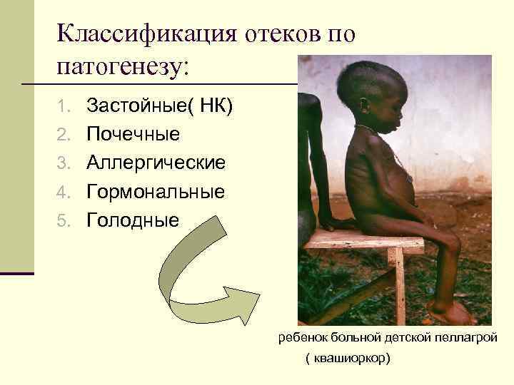 Классификация отеков по патогенезу: 1. Застойные( НК) 2. Почечные 3. Аллергические 4. Гормональные 5.