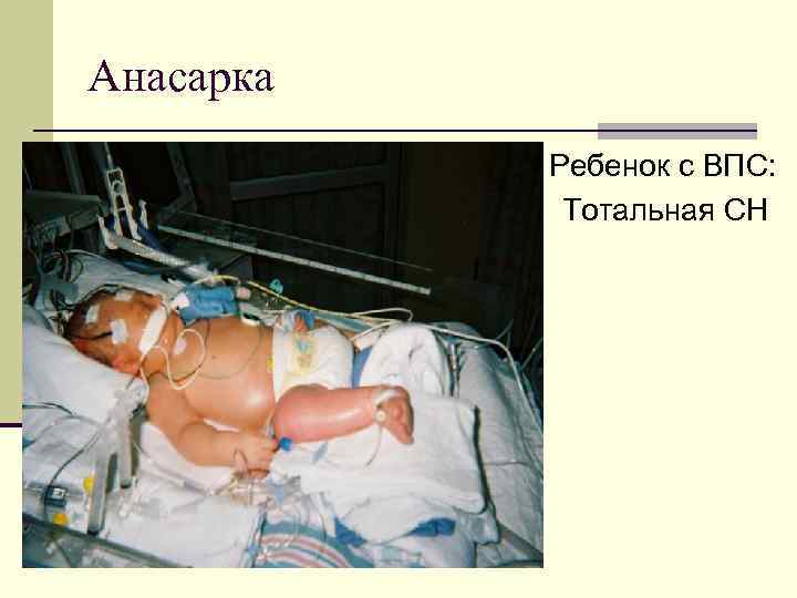 Анасарка n Ребенок с ВПС: Тотальная СН 