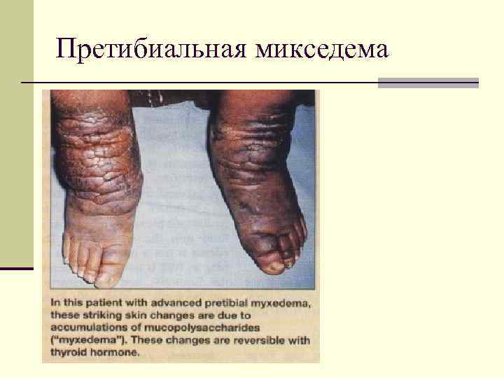 Претибиальная микседема 